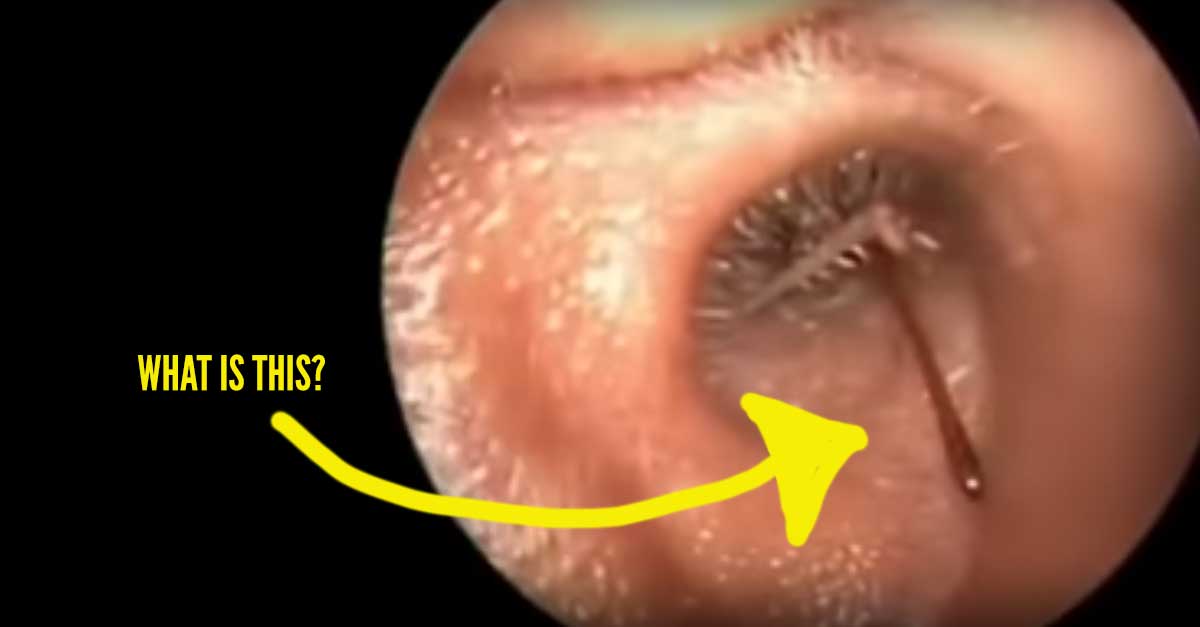 You Won’t Believe What Doctors Found Inside This Man’s Ear | Cool