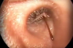 You Won’t Believe What Doctors Found Inside This Man’s Ear