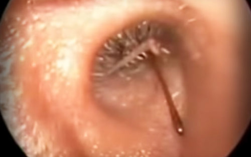 You Won’t Believe What Doctors Found Inside This Man’s Ear